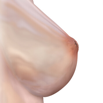 inverted-nipple-treatment
